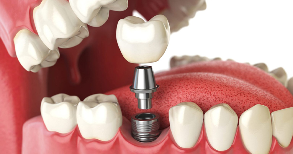 ایمپلنت های دندانی: آنچه باید بدانید