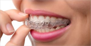 استفاده از محافظ دهان