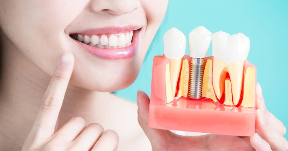 چگونه عمر ایمپلنت های دندانی خود را افزایش دهیم؟