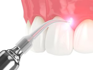 مزایا و معایب استفاده از لیزر در دندانپزشکی چیست؟