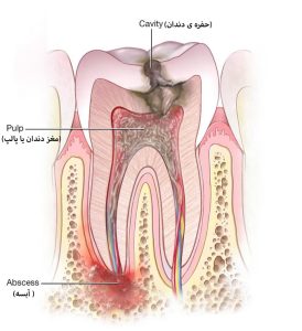 آبسه دندان