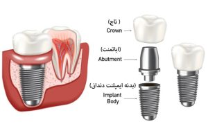  ساختار سیستم ایمپلنت دندانی
