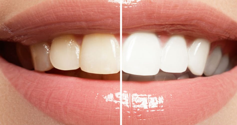 سفید کردن دندان چیست؟