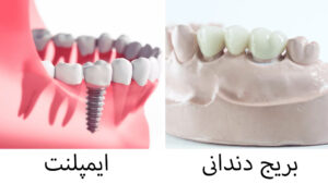بریج های دندانی در مقابل ایمپلنت ها