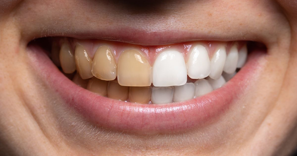 6 علت زردی دندان