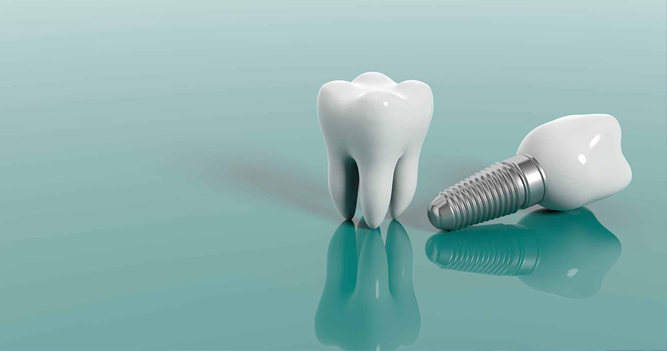 20 سوالی که باید از دندانپزشک خود در مورد ایمپلنت دندان بپرسید