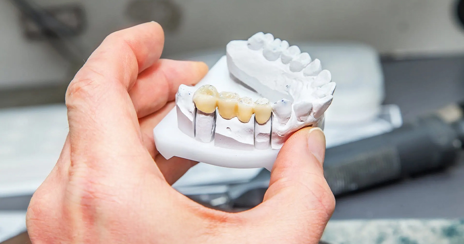 چرا بریج های دندانی راه حلی عالی برای دندان های از دست رفته هستند: 3 مزیت کلیدی