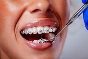 چه زمانی باید به یک ارتودنتیست مراجعه کنم؟