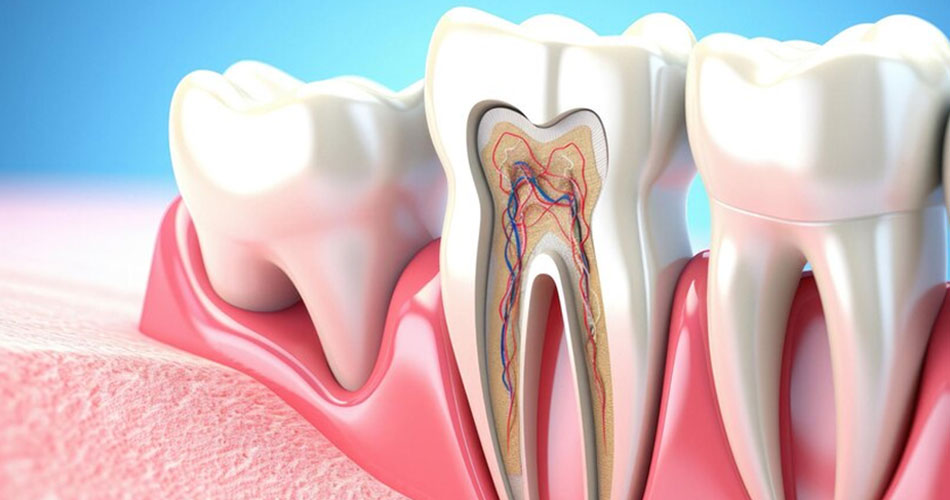 مقابله با عفونت های مکرر کانال ریشه