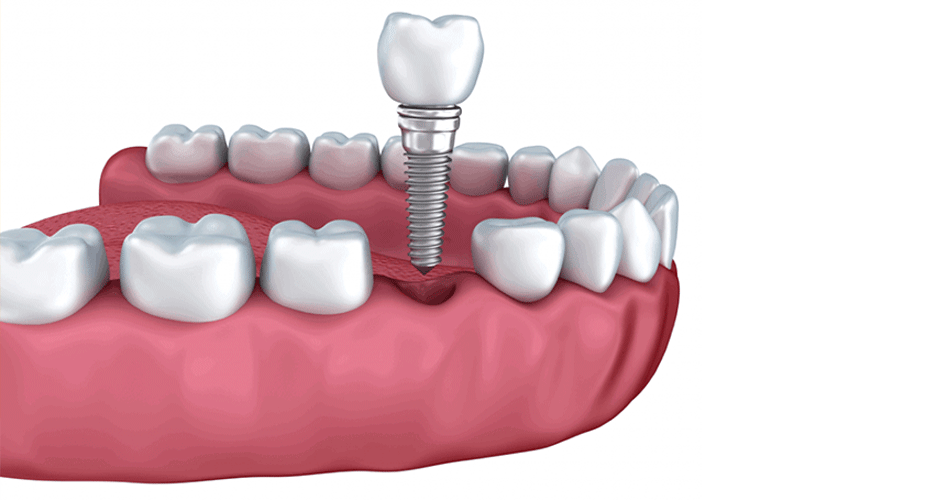 علل شایع ناموفق بودن ایمپلنت دندان