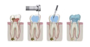 علل و علائم عفونت کانال ریشه چیست