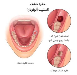 حفره خشک (استئیت آلوئولار)