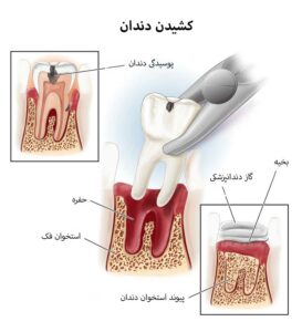 کشیدن دندان چیست