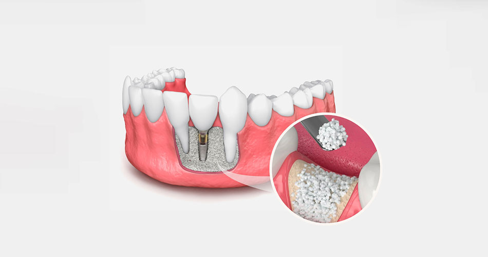 ترمیم استخوان برای ایمپلنت‌های دندانی: آنچه باید بدانید