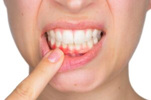 لثه‌های قرمز و متورم 